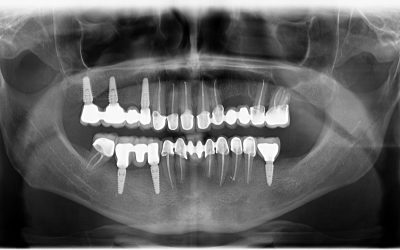 Ortodontie, aparat dentar invizibil, chirurgie orala, pedodontie - stomatologie copii/ pediatrica, reabilitare orala, implantologie fara taieturi, implat dentar garantie, fatete dentare minim invazive, coroane dentare E-max, tratamente endodontice la microscop, Clinica Unu Brașov 2023